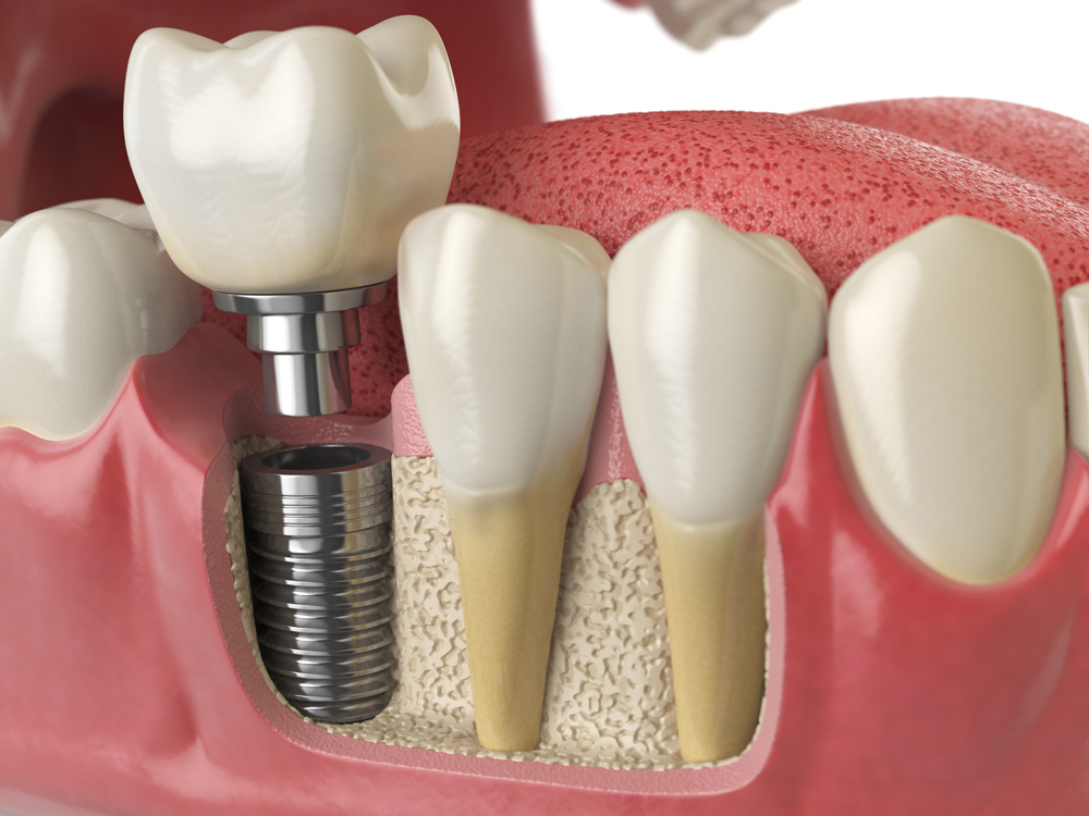Anatomy of healthy teeth and tooth dental implant at Wildhorse dental by Dr. Miller
